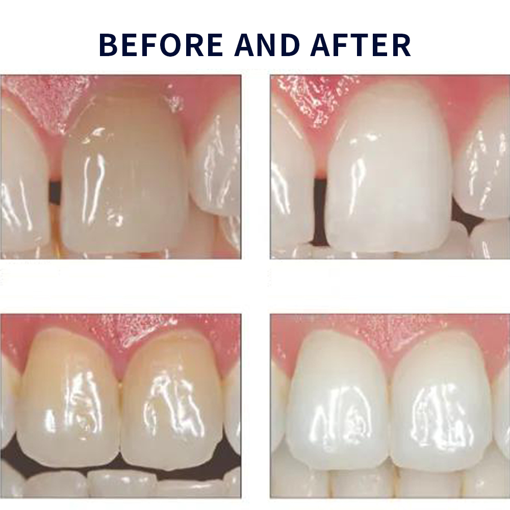 Opalescencia blanqueadora 20%  - Teeth Whitening At Home Kit reseña y precio