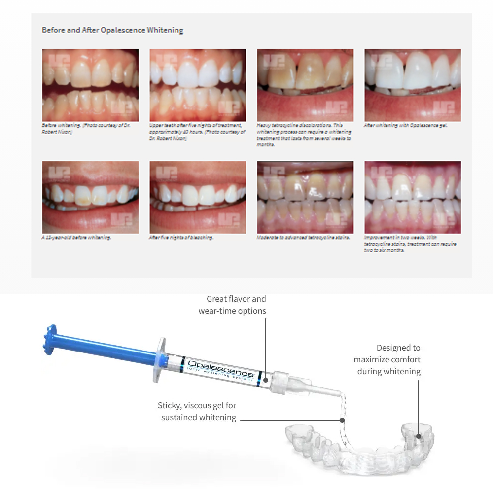 Opalescencia blanqueadora 20%  - Teeth Whitening At Home Kit reseña y precio