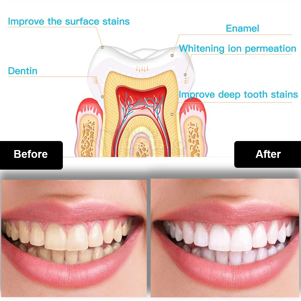 Kit de blanqueamiento Dental M - Teeth Whitening With Trays reseña y precio